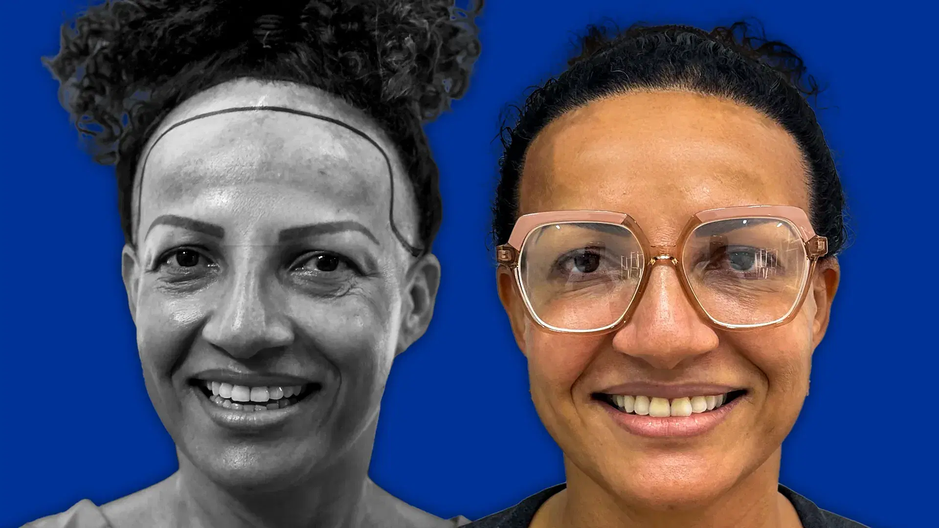 female hair transplant Aftercare and Results