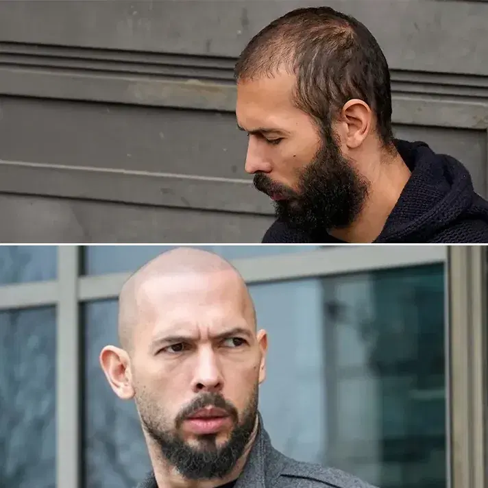 Transplante Capilar de Andrew Tate