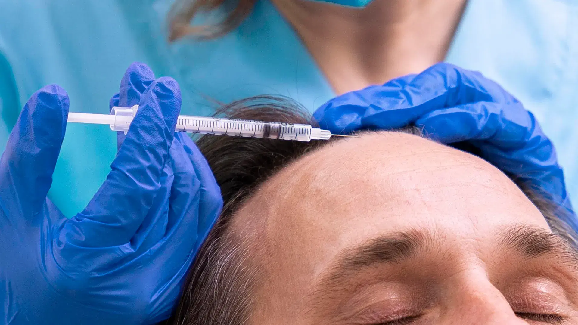 Benefícios da Mesoterapia Capilar