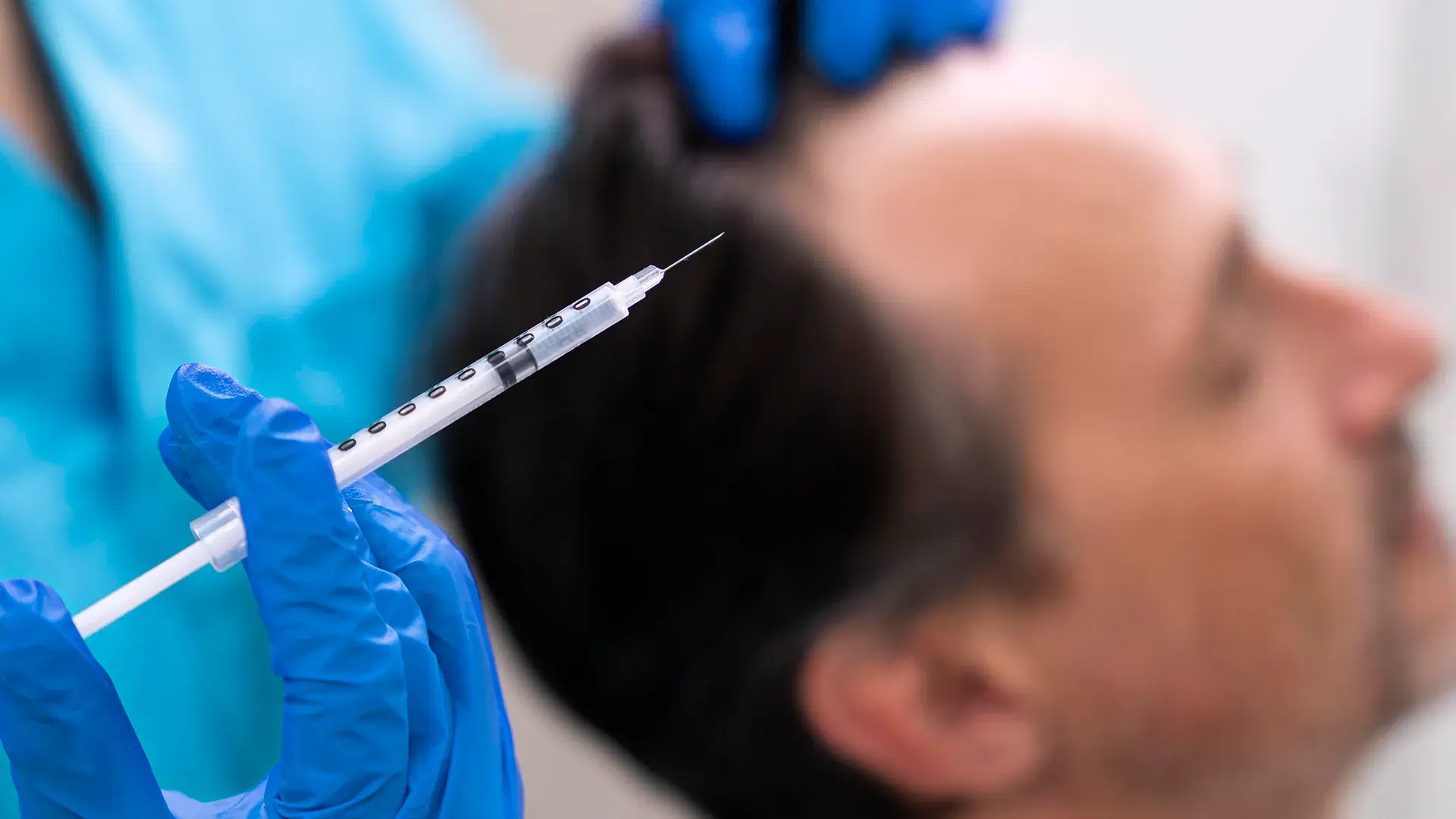 O que é Mesoterapia Capilar?