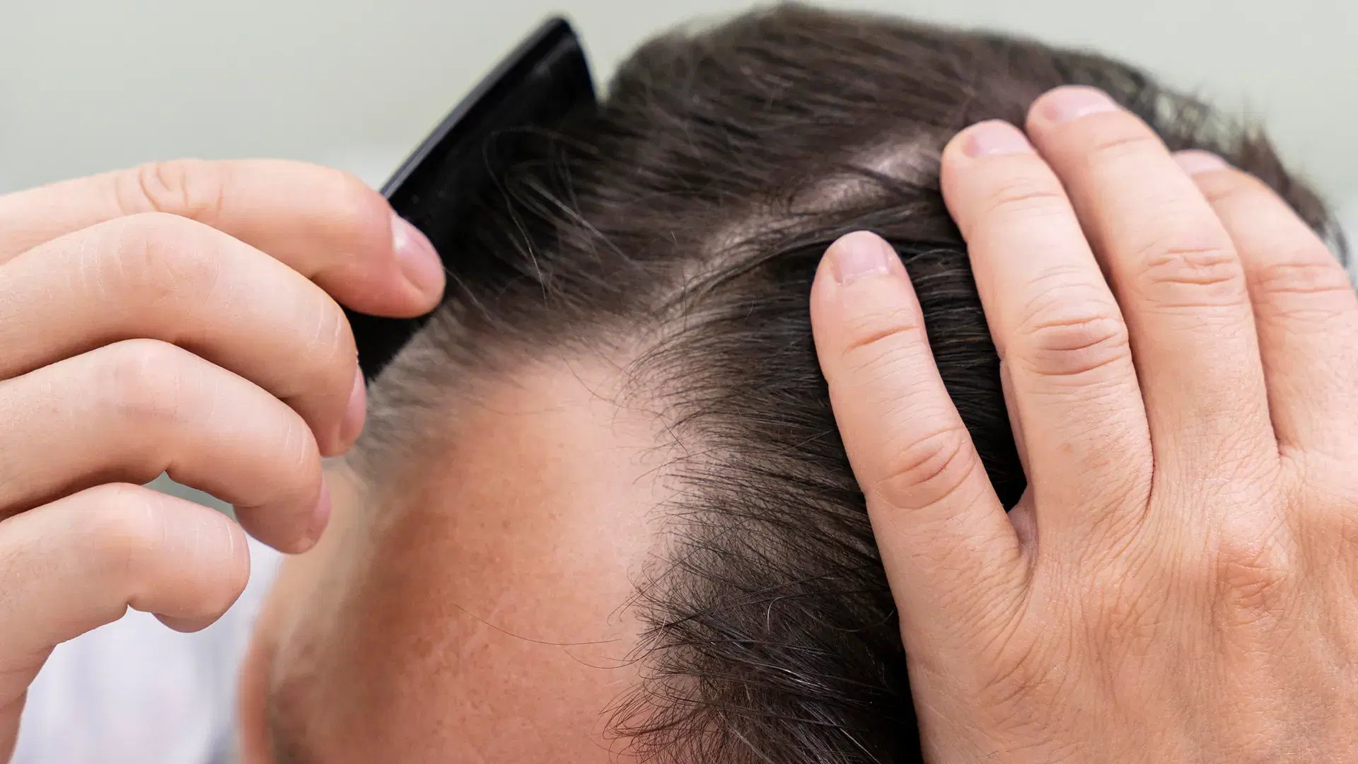 ¿Qué es el tratamiento PRP para el cabello?