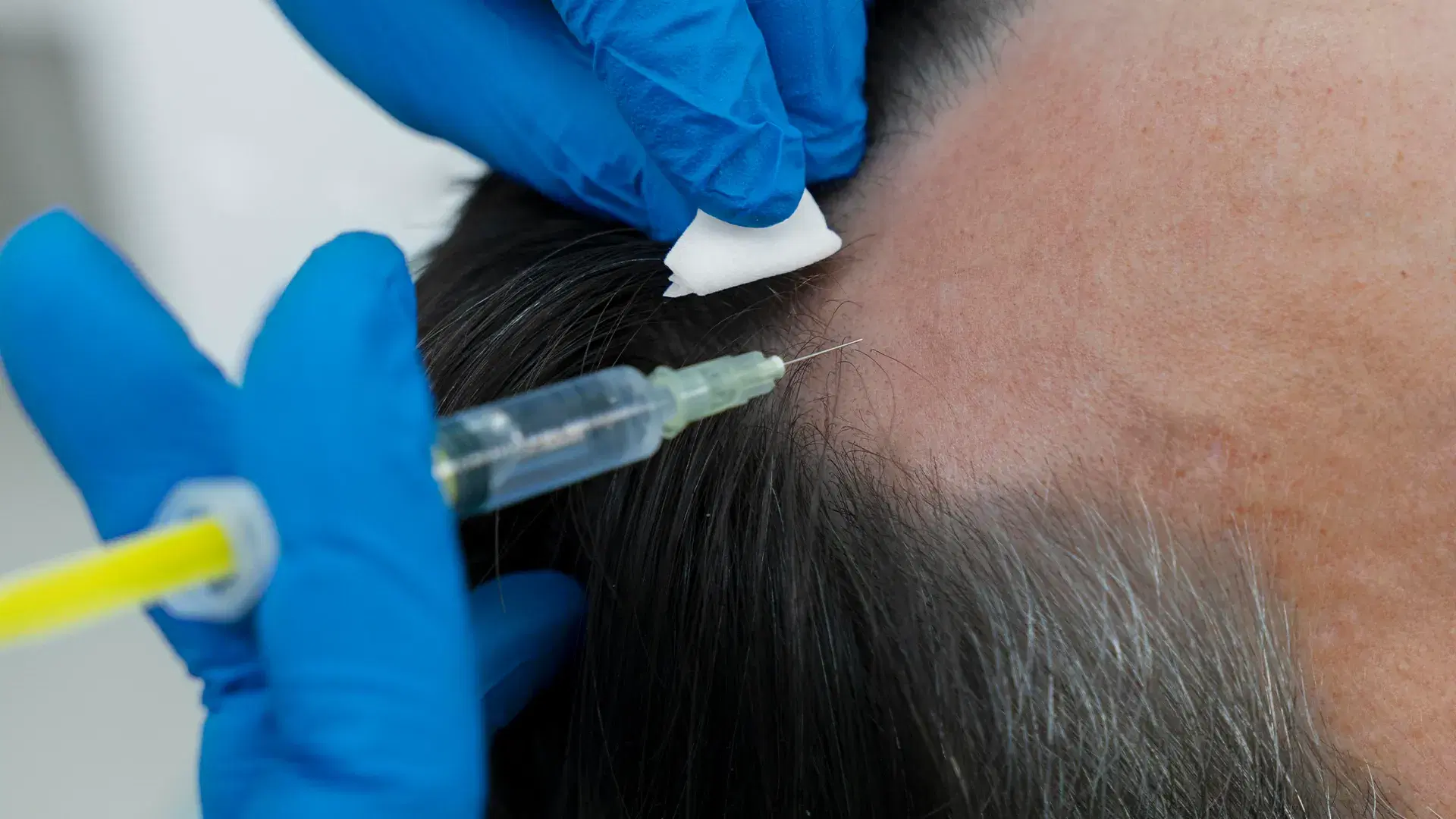 O que é a terapia com células-tronco para o cabelo?
