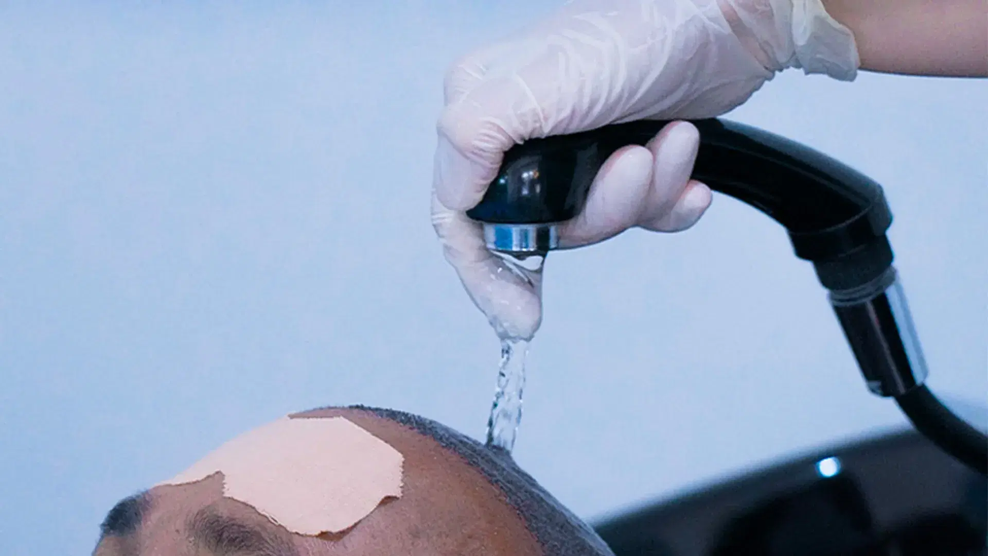 unshaven hair transplant Aftercare and Recovery