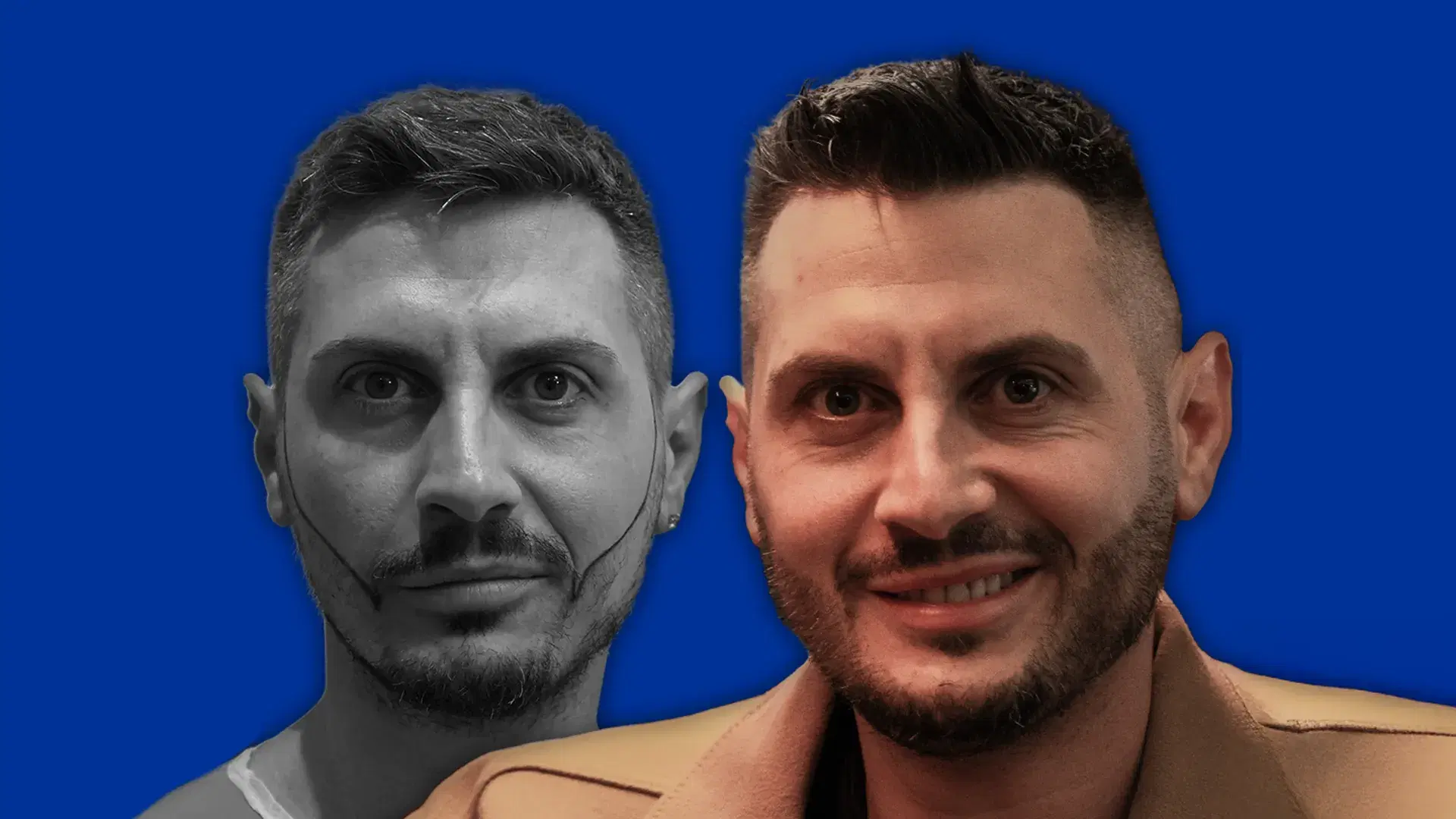 Restauração da Barba Cuidados Pós-Procedimento e Recuperação