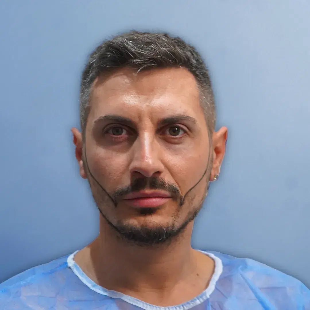 Transplante de barba