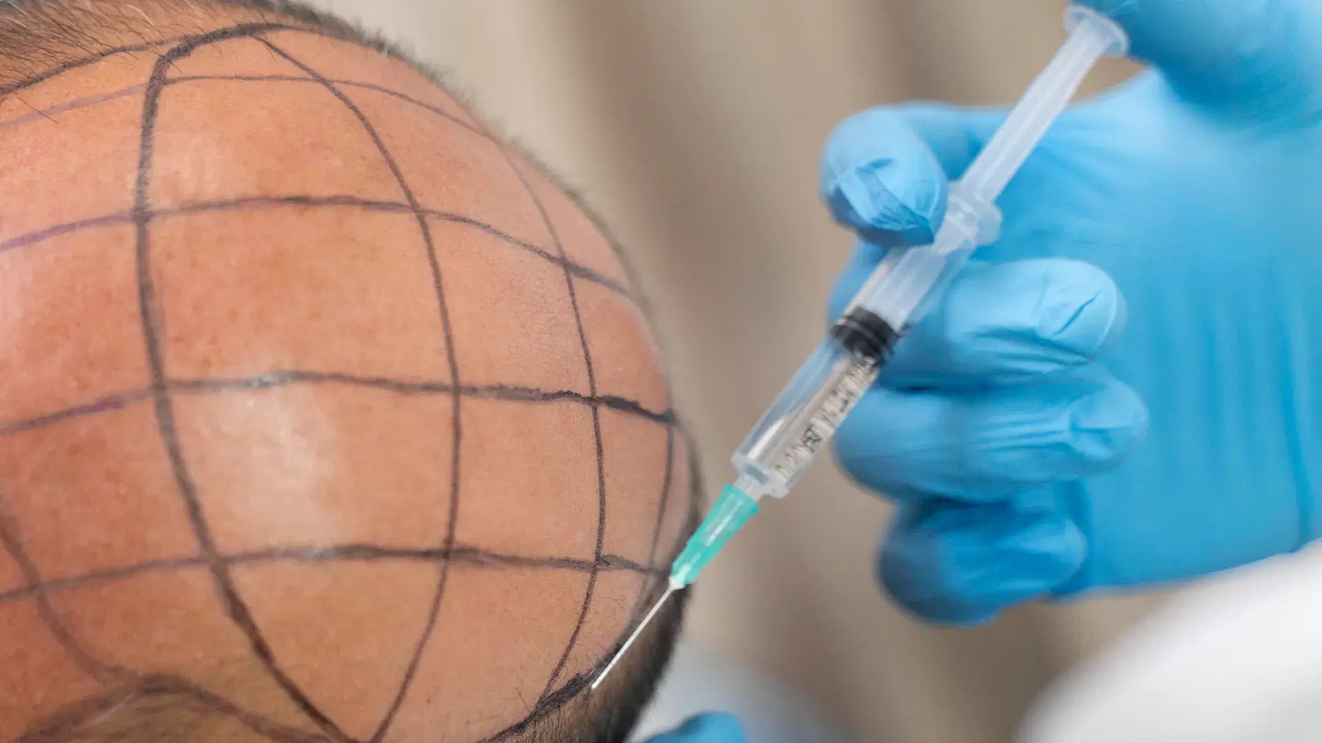 Benefici del Trattamento con Cellule Staminali per i Capelli