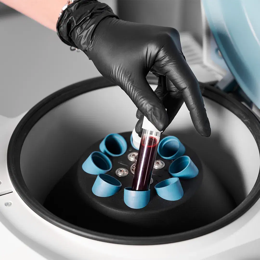 <p><span style="color: rgb(247, 248, 248);"><strong>Extracción de sangre y preparación del plasma</strong></span></p>