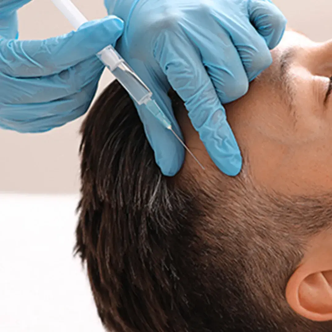 Mesoterapia para Cabelo: Revitalize seu couro cabeludo e fortaleça o crescimento
