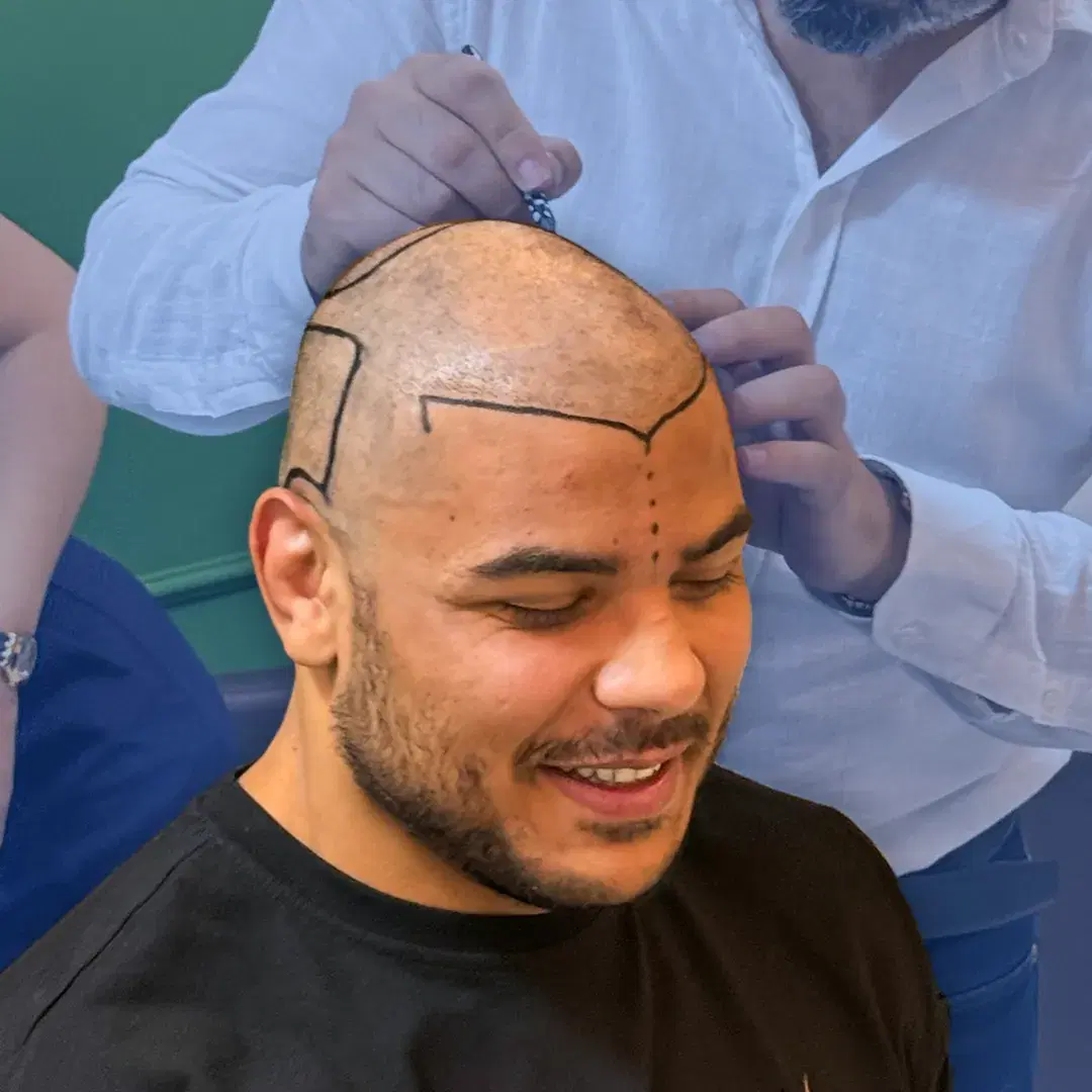 EstheticHairTurkey: La Migliore Clinica per Trapianto di Capelli in Turchia