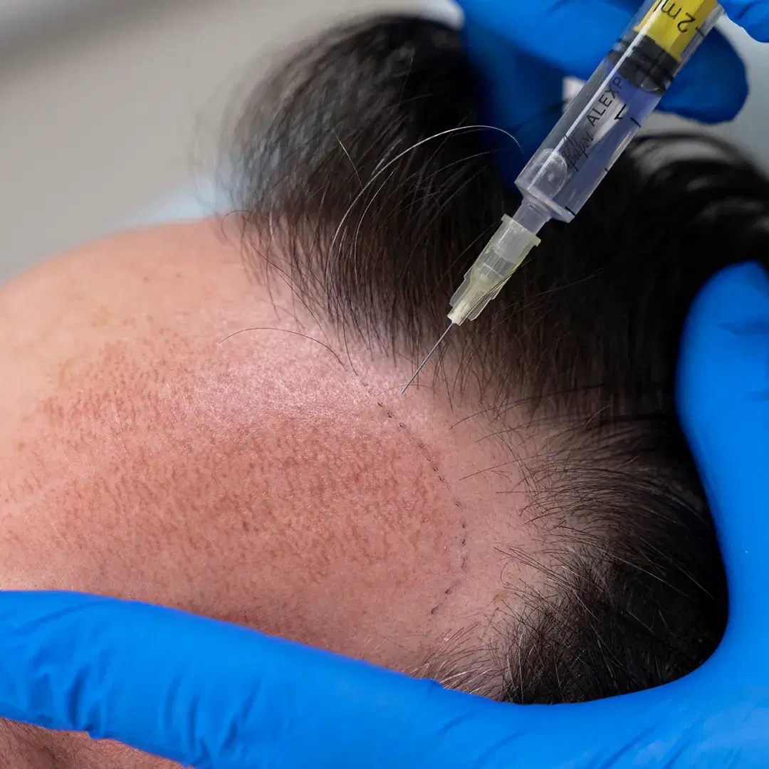 Terapia com Células-Tronco para o Cabelo: Revitalize Seu Cabelo Naturalmente