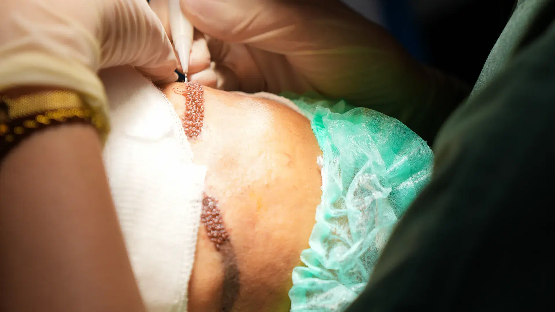 La procedura di trapianto delle sopracciglia presso Esthetic Hair Turkey