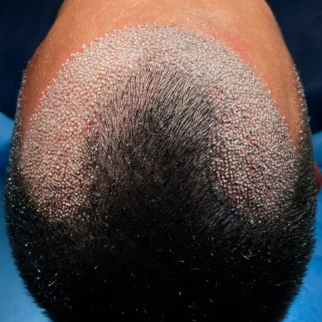 Unshaven Hair Transplant Perfect for Busy Lifestyles