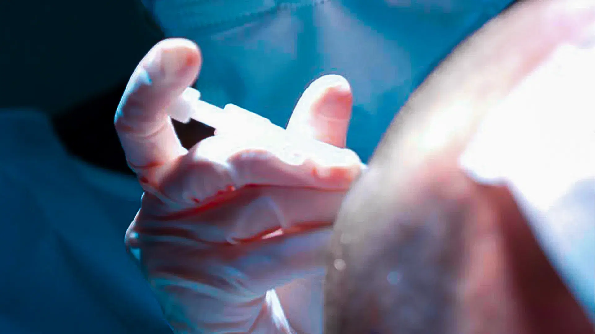 Was passiert während einer Haartransplantation?