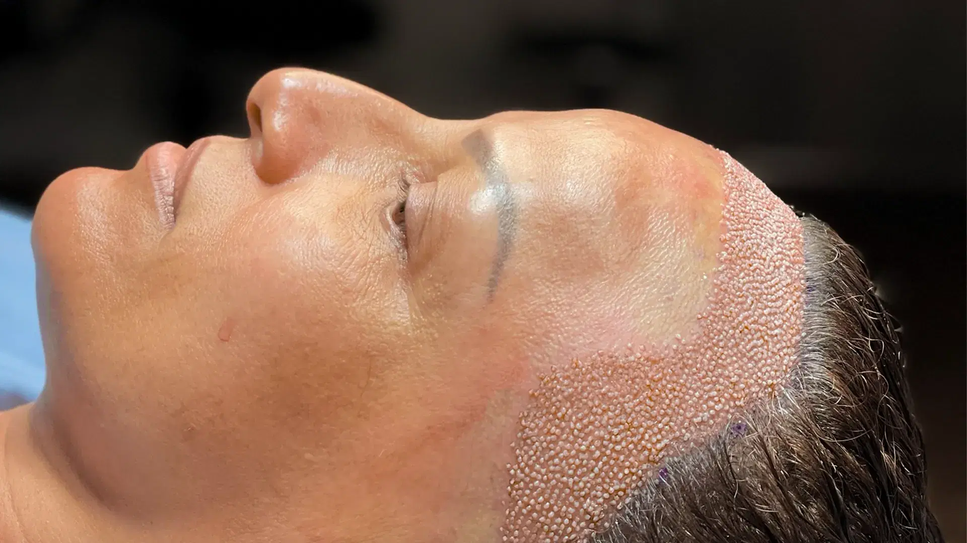 The DHI Technique for Women