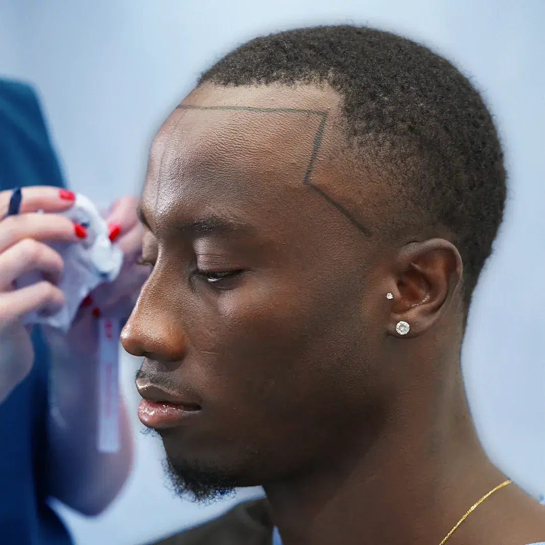 Afro Hair Transplant – Crafted for Unique Hair Patterns