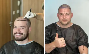 Who Is Suitable For Hair Transplantation?